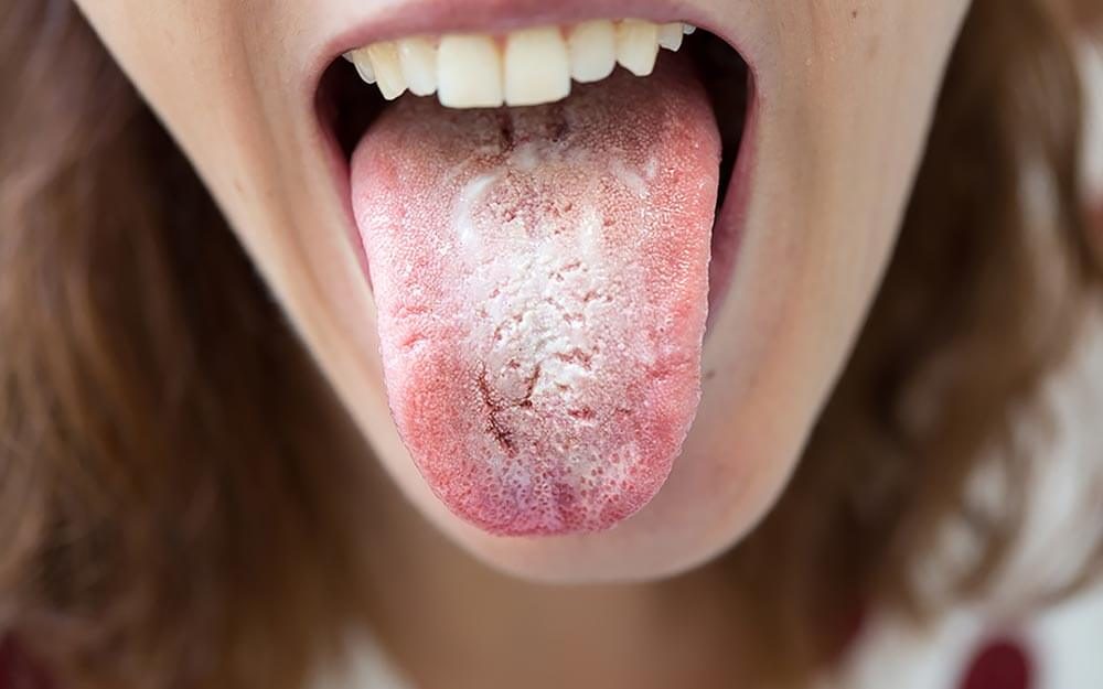 tongue diagnose
