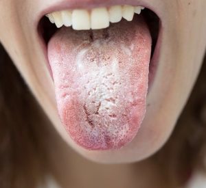 Ayurvedic Tongue Reading 